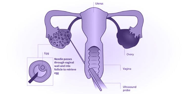 Pengambilan Sel Telur dan Sperma